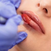 microlabial